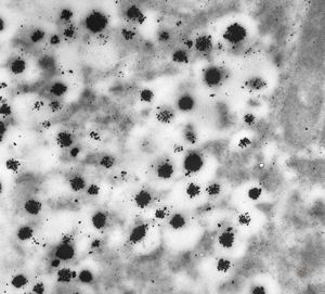 F, 68y. | APUD carcinoma mammae - Bodian impregnation F, 68y. | APUD carcinoma mammae - Bodian impregnation